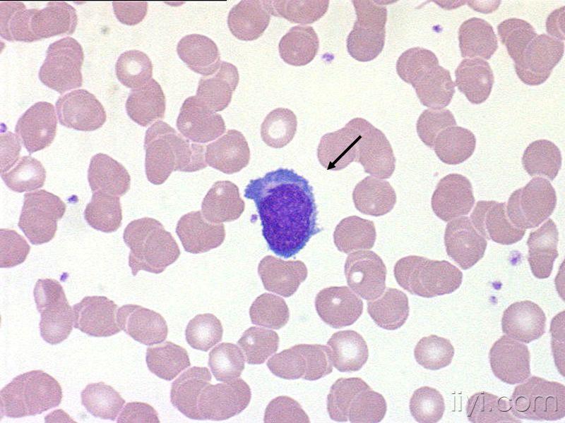 日本血液學會的異型淋巴細胞圖片