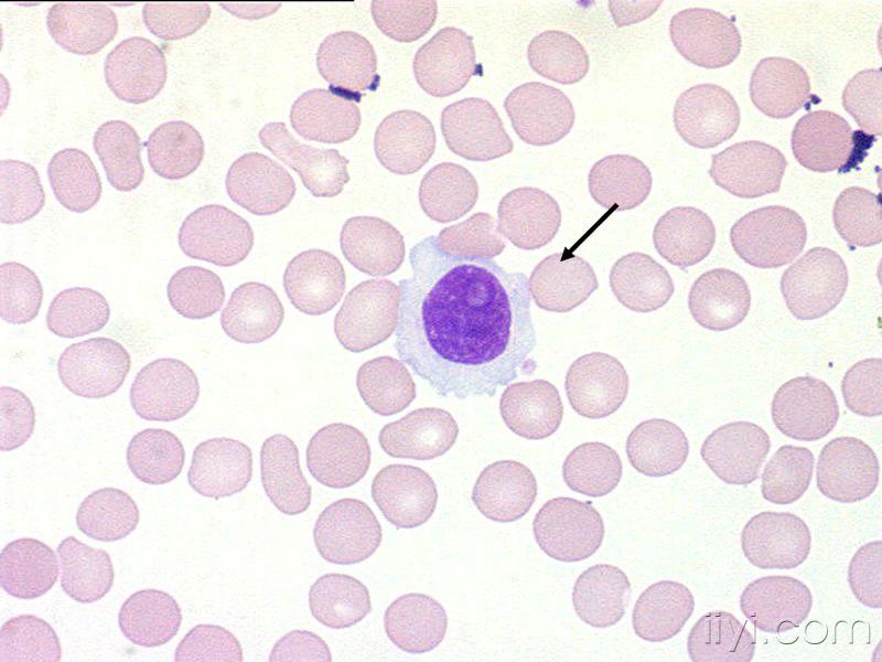 异性淋巴细胞图片
