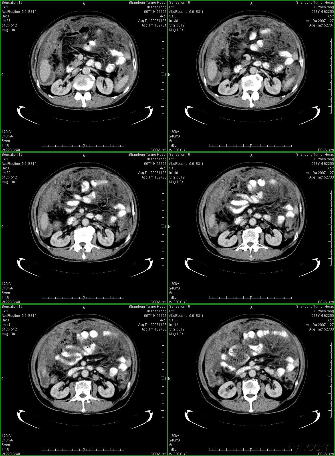 典型的大网膜肠系膜转移瘤很经典
