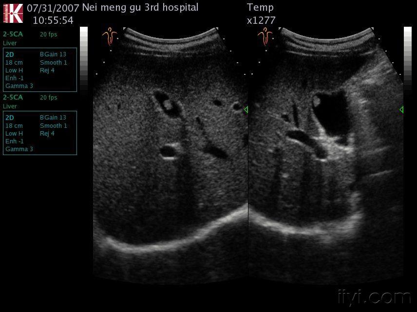 胆囊息肉,看了忘不了 超声医学讨论版 爱爱医医学论坛