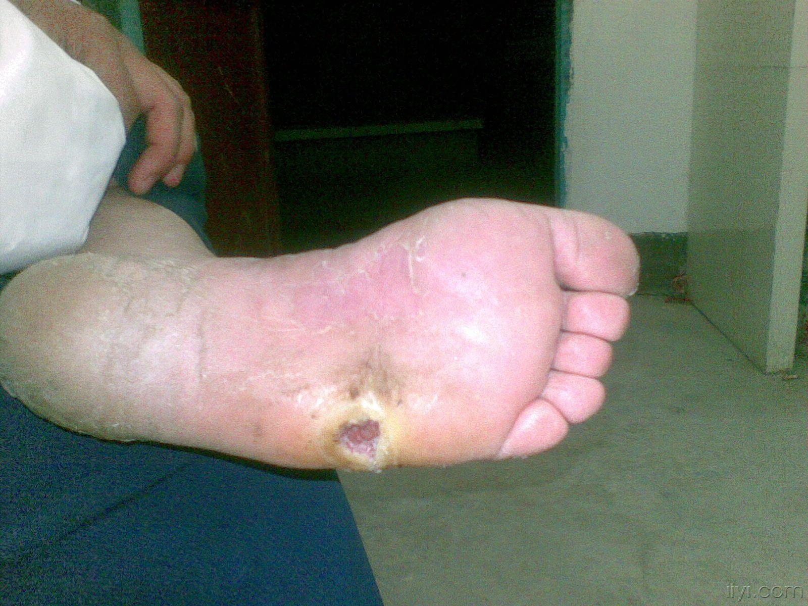 艾滋病脚上症状图片图片