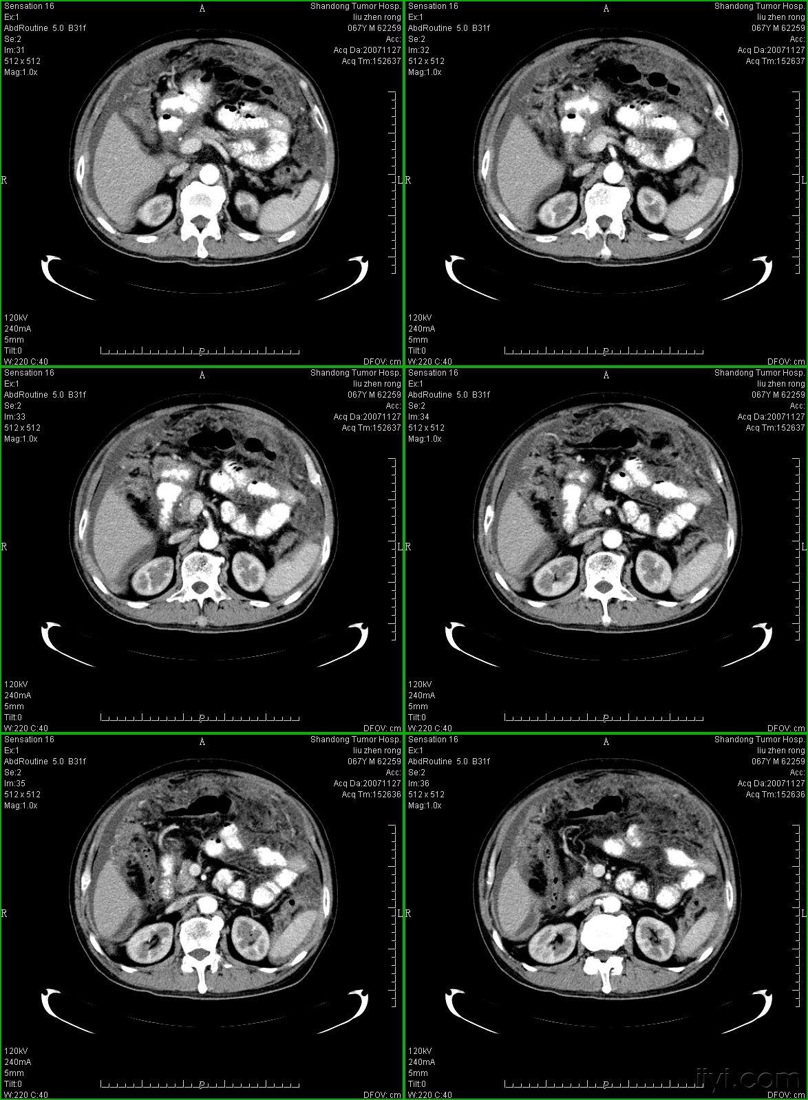 典型的大网膜,肠系膜转移瘤,很经典