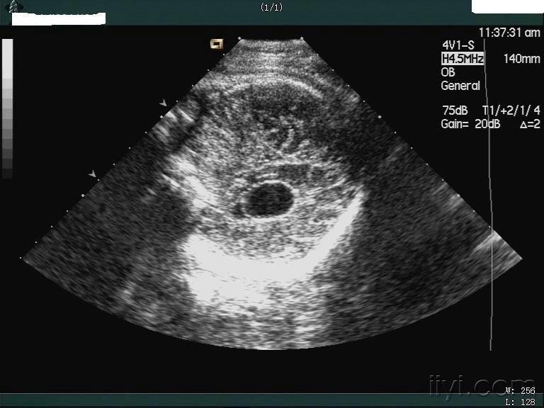 杏林过客说胎儿畸形之-脉络丛囊肿 - 超声医学讨论版 - 爱爱医医学