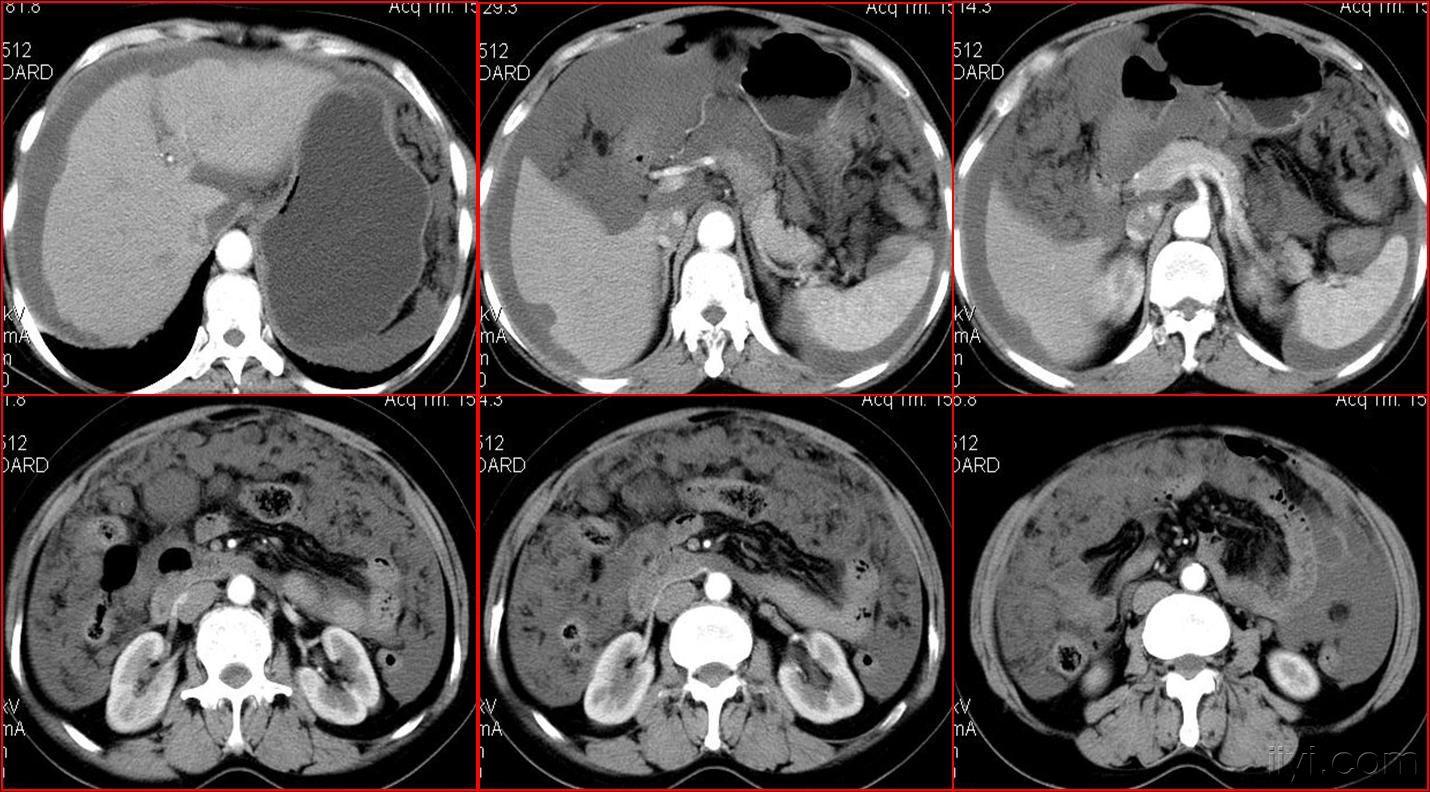 典型的大网膜,肠系膜转移瘤,很经典