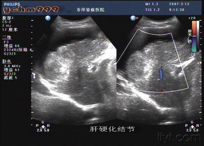 肝硬化声像图五大特点图片