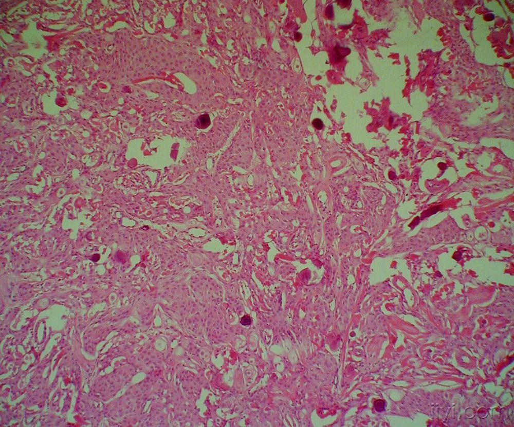 ssp-12(特殊类型的脑膜瘤)