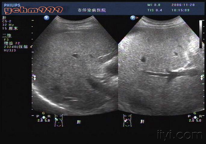 肝硬化声像图五大特点图片