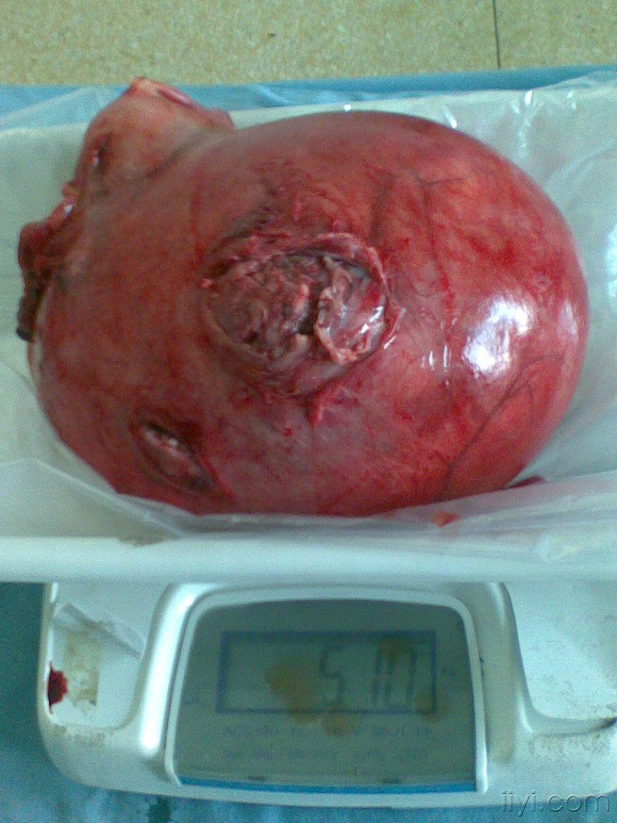 你见过这么大的子宫肌瘤吗