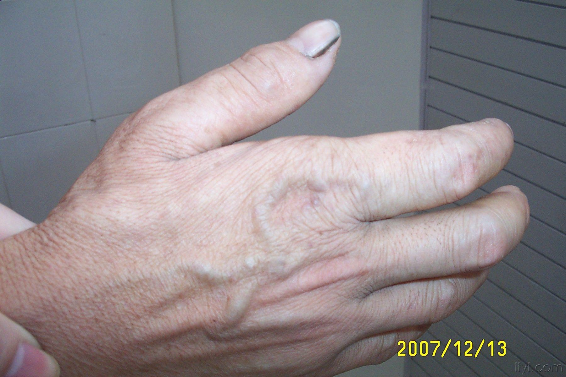 手部血栓的症状图片图片