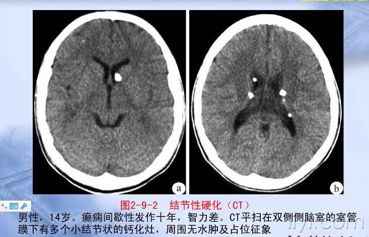 【专题讲座】关于颅内钙化
