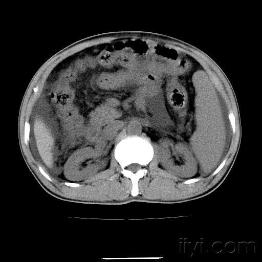 上腹部ct平扫增强