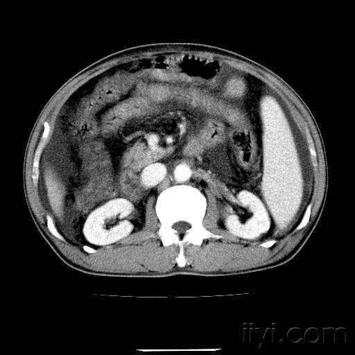 上腹部ct平掃增強