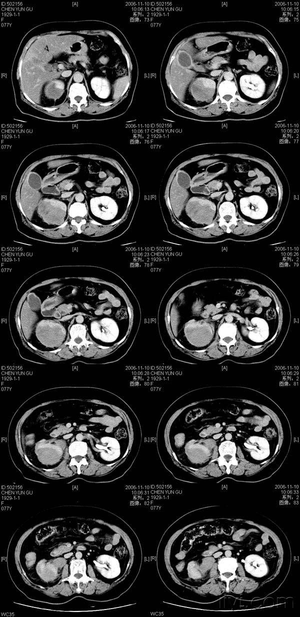 肾脏病变(12.30公布病理)结果已公布