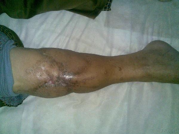 胫腓骨骨折4年一例 骨科与显微外科专业讨论版 爱爱医医学论坛