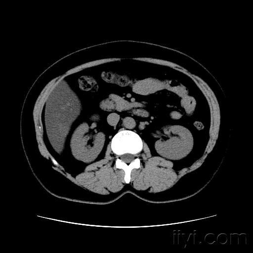 肾脏ct大家帮忙看一下