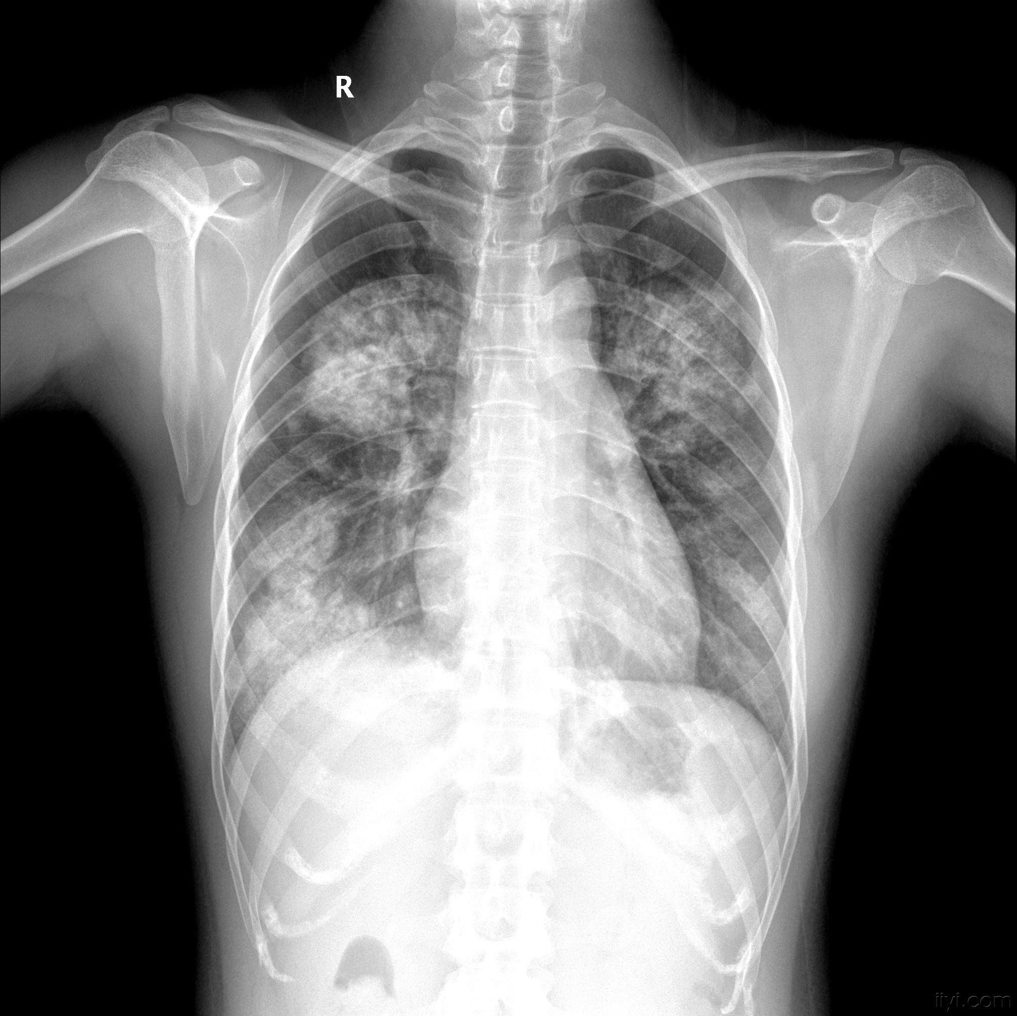 典型病例大家先看看看有多少人认识已公布病例结果