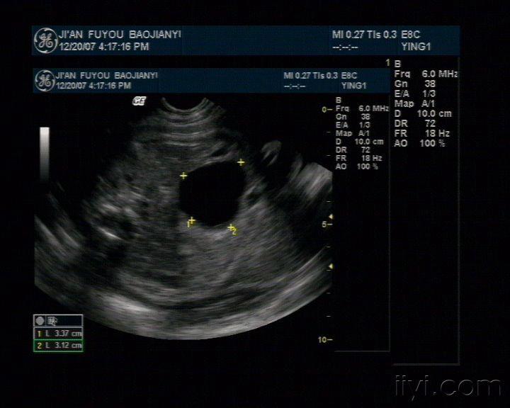 胎儿腹腔囊肿图片