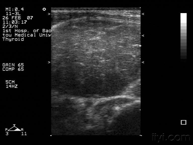 典型的桥本甲状腺炎 