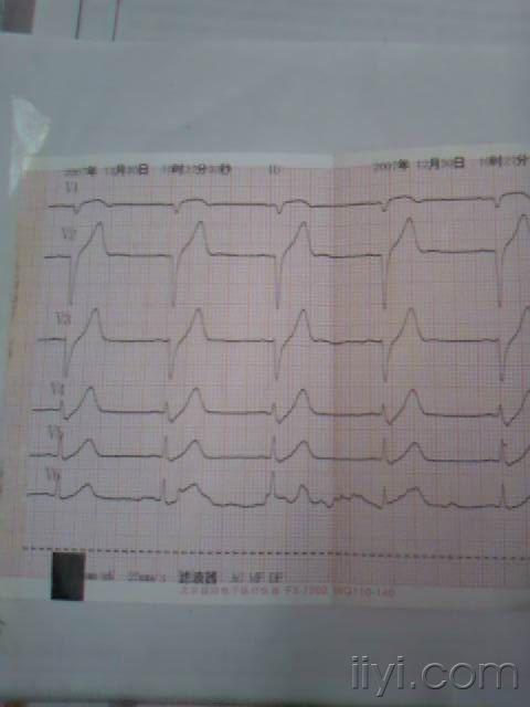 v2-v3r波上升不良