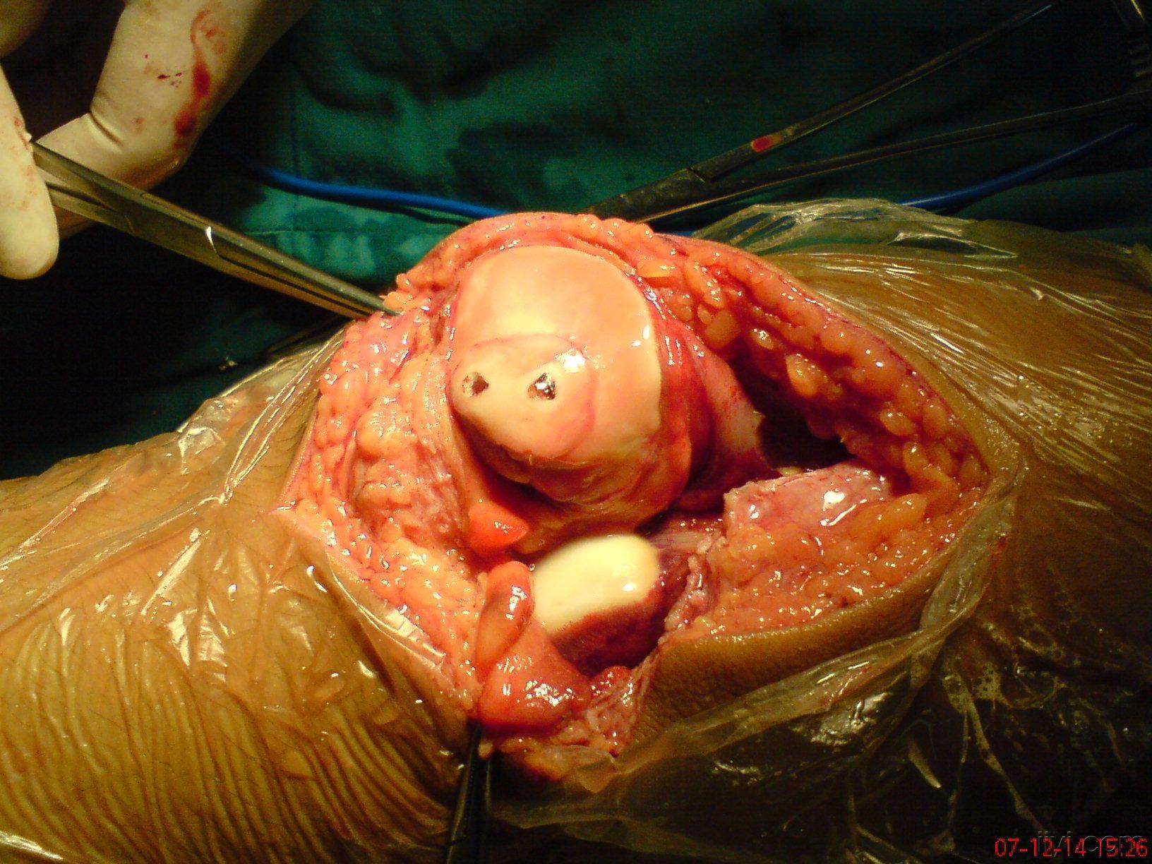 复位可吸收螺钉固定后