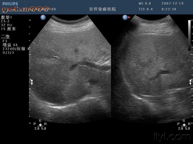 酒精肝超声声像图图片图片