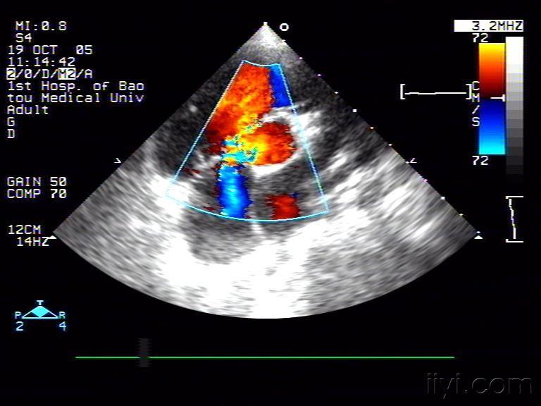 三尖瓣瓣叶超声区分图图片