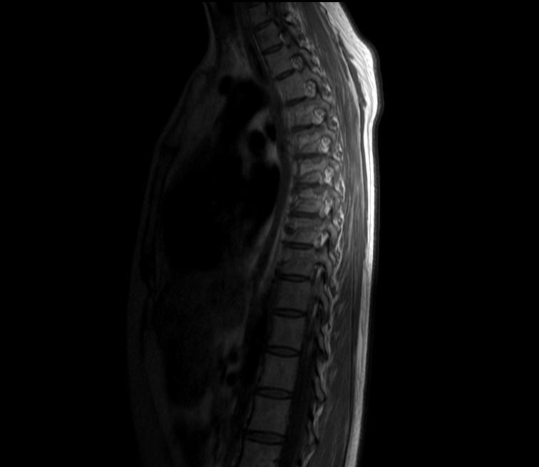 不好意思请帮忙看看胸椎mri