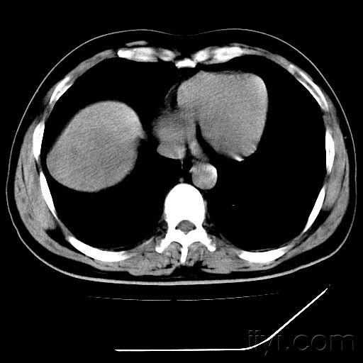 上腹部ct