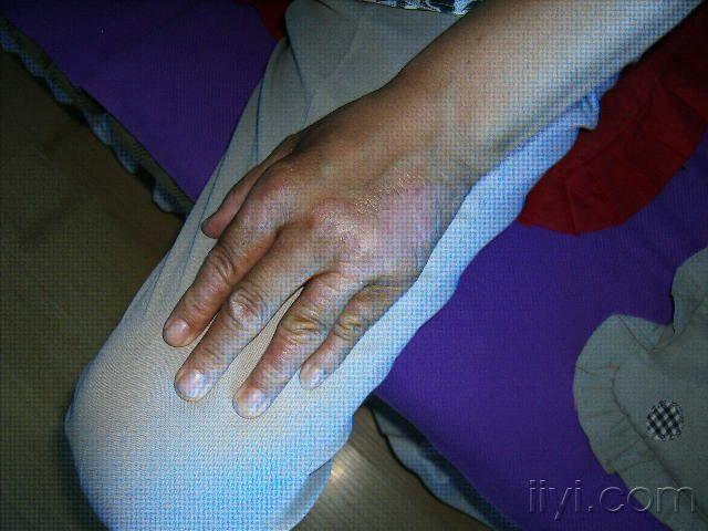 火针治疗牛皮癣
