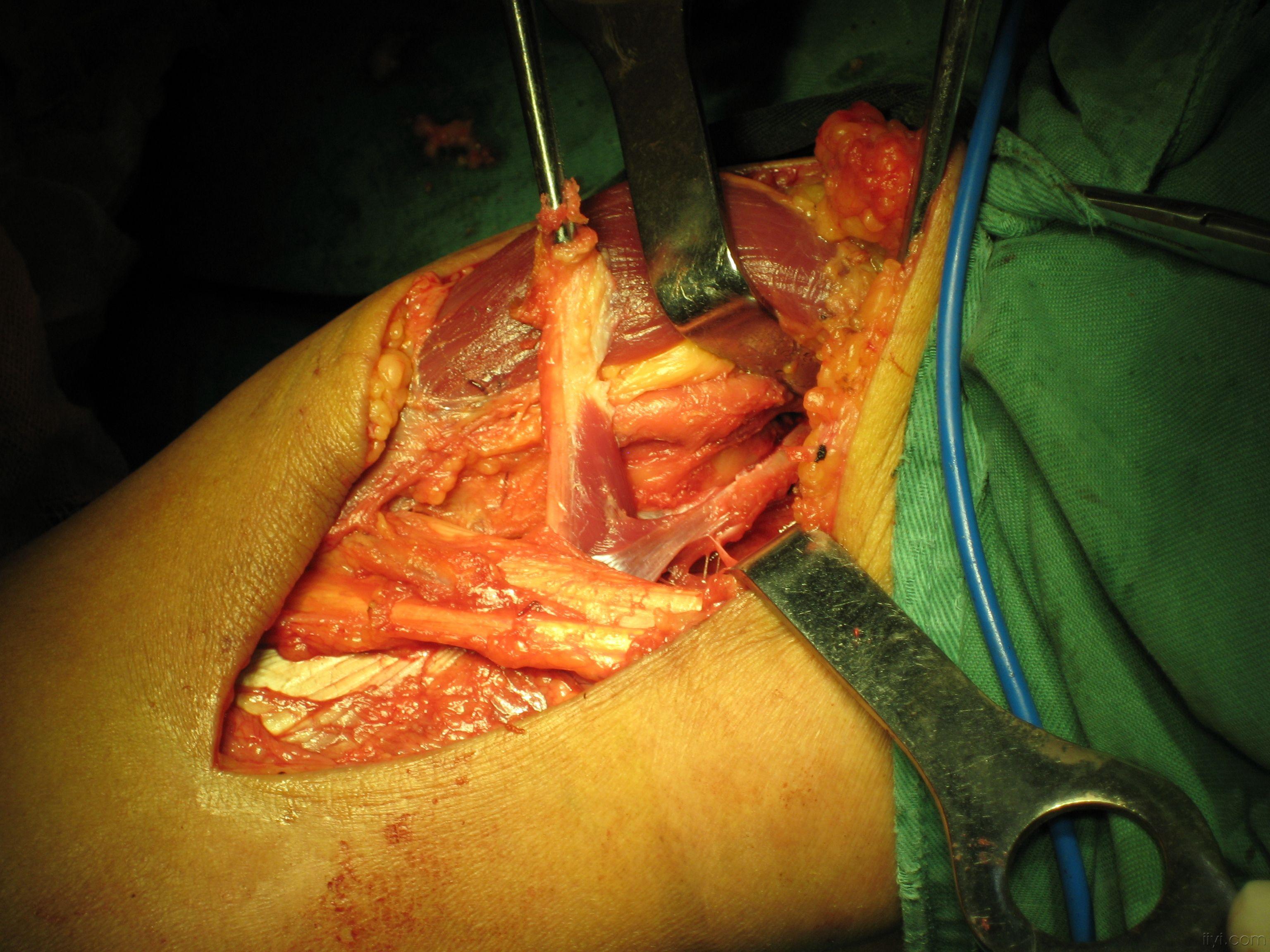 后交叉韧带急性损伤伴外侧副韧带损伤