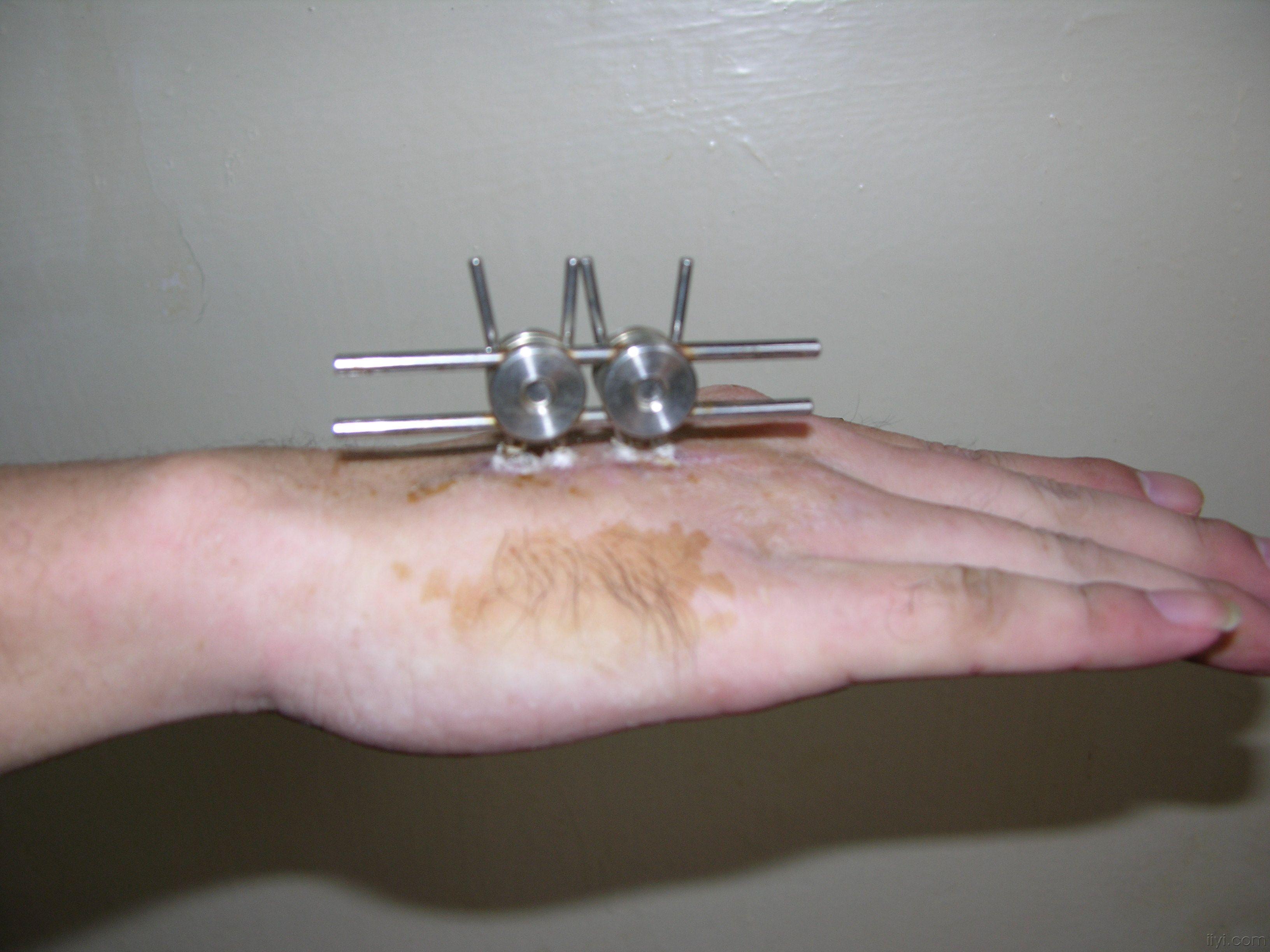 掌骨外固定架,看看怎么样!