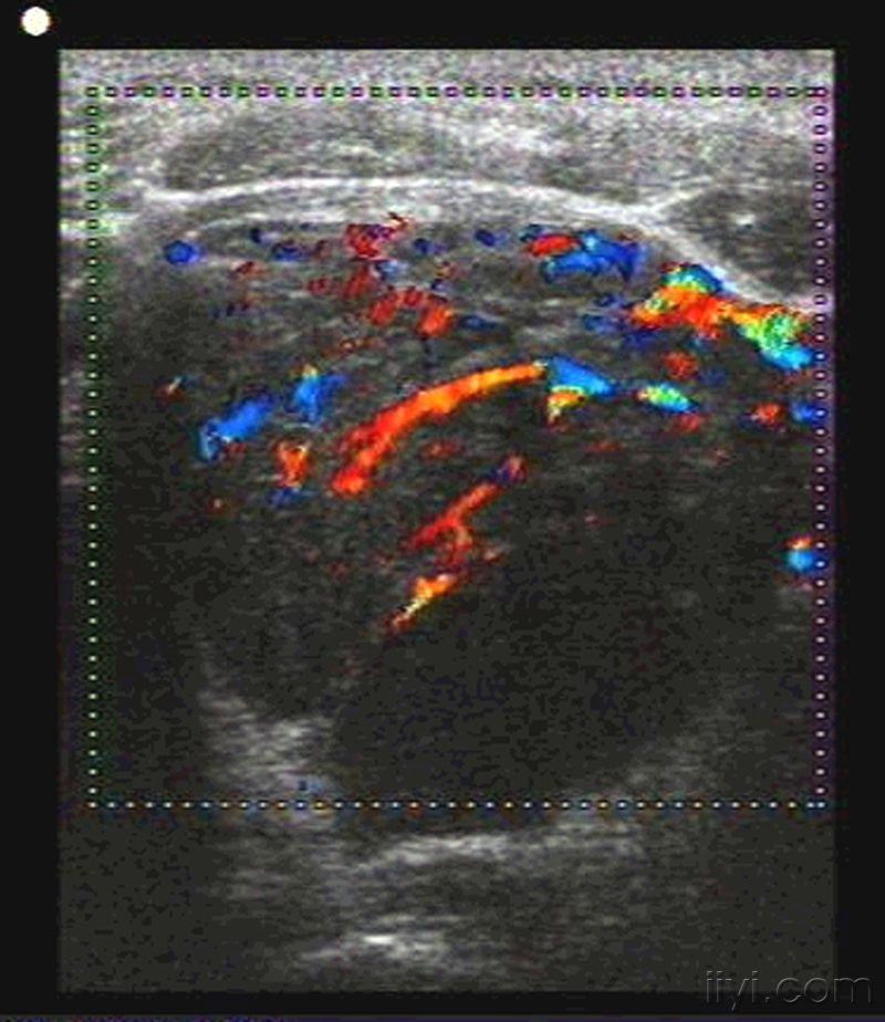 典型桥本甲状腺炎 