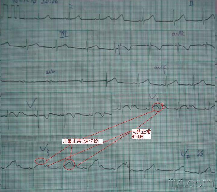 大家帮忙分析一下这份心电图