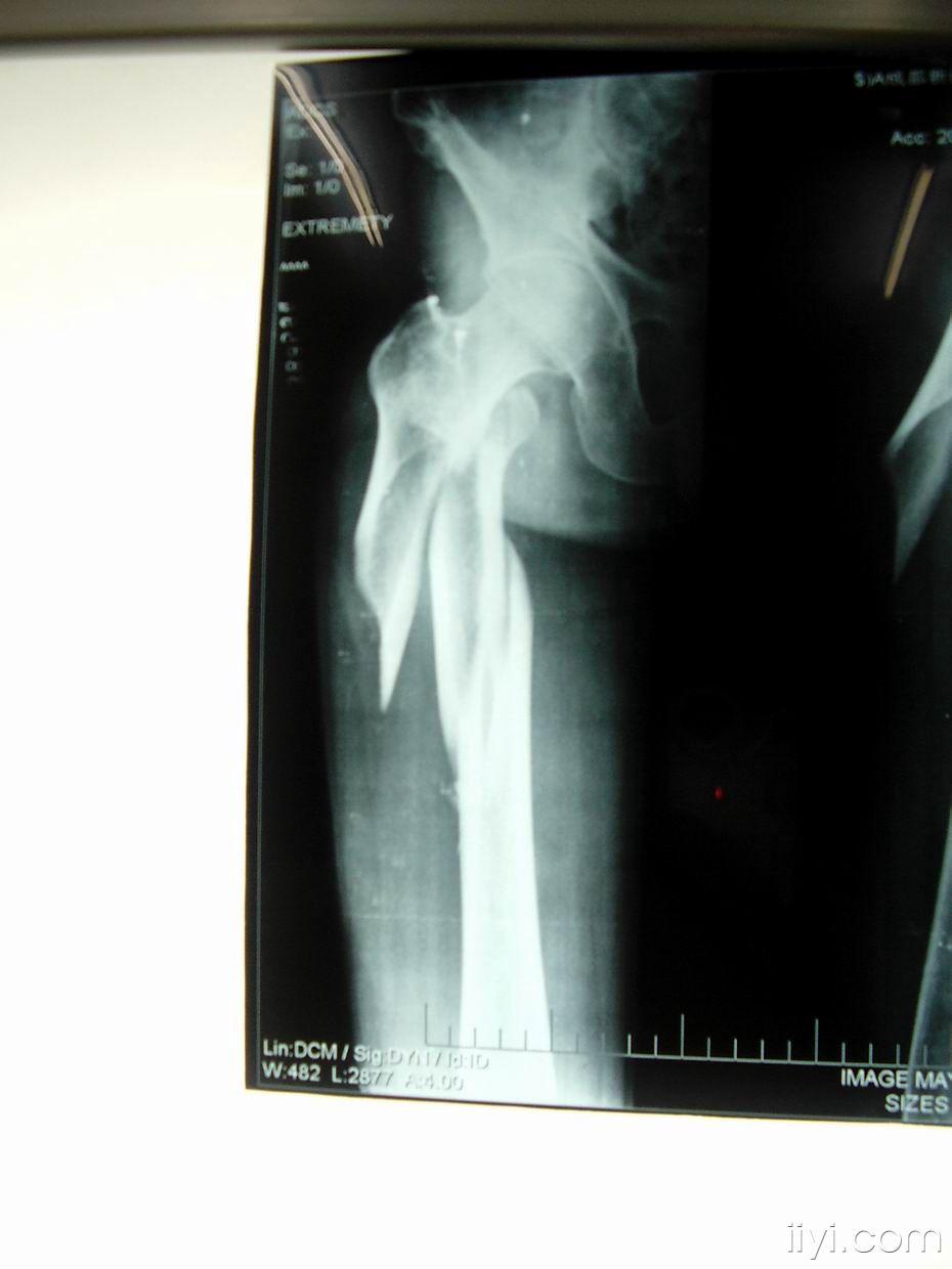 右股骨转子下粉碎性骨折请各位讨论