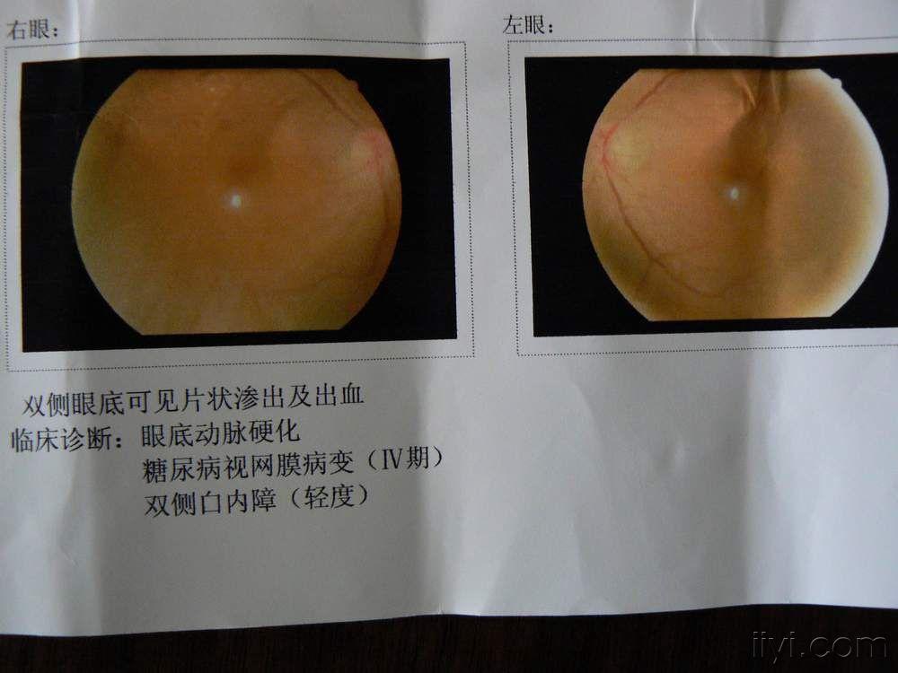 请教眼底出血怎么治疗