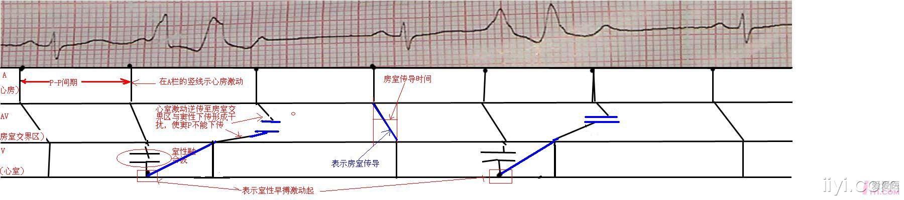 室早梯形圖解