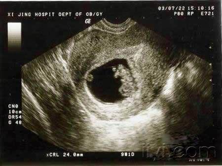 怀孕彩超照片初期图片