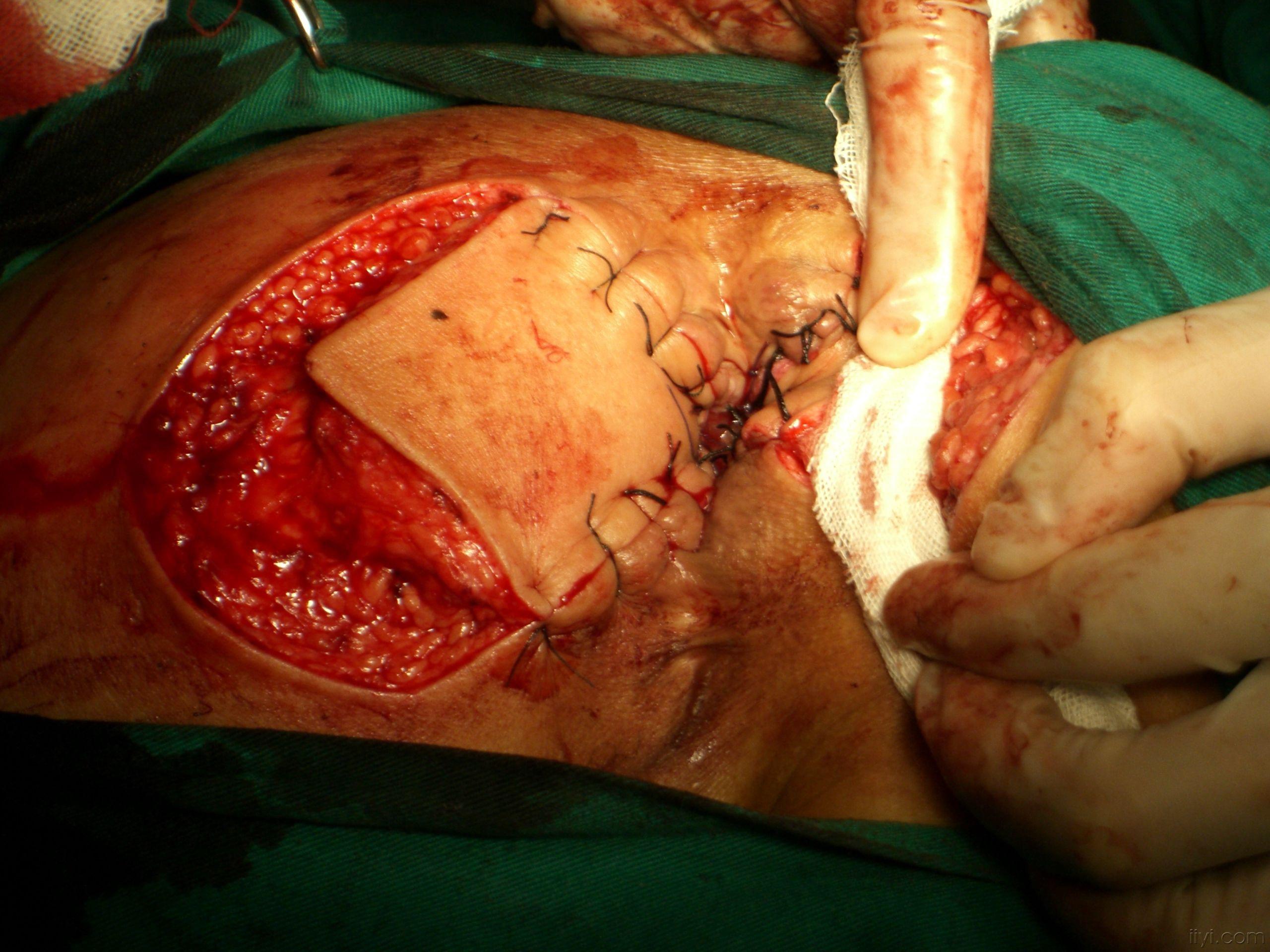重度管状肛瘘狭窄的手术