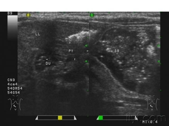 典型婴儿幽门梗阻