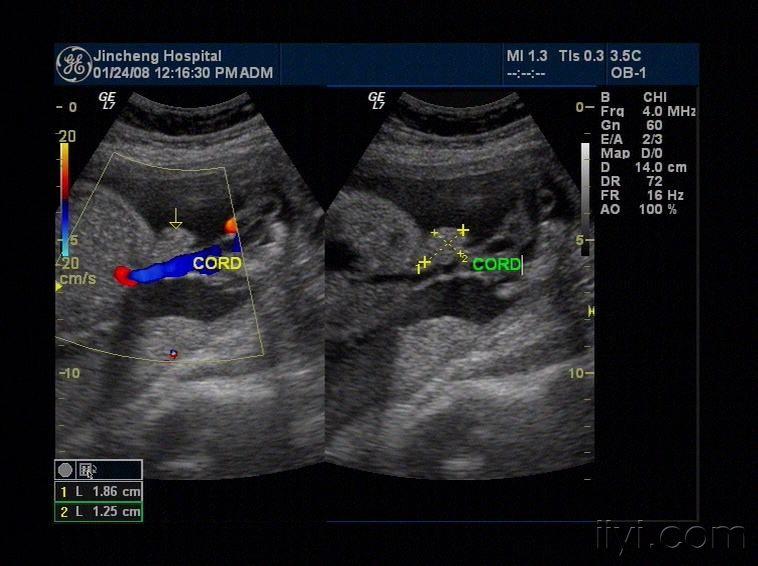 单脐动脉一例伴脐部膨出物