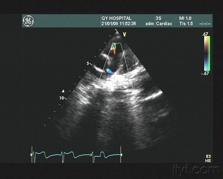 主-肺动脉间隔缺损?(7.15上传上级医院检查结果 6楼)