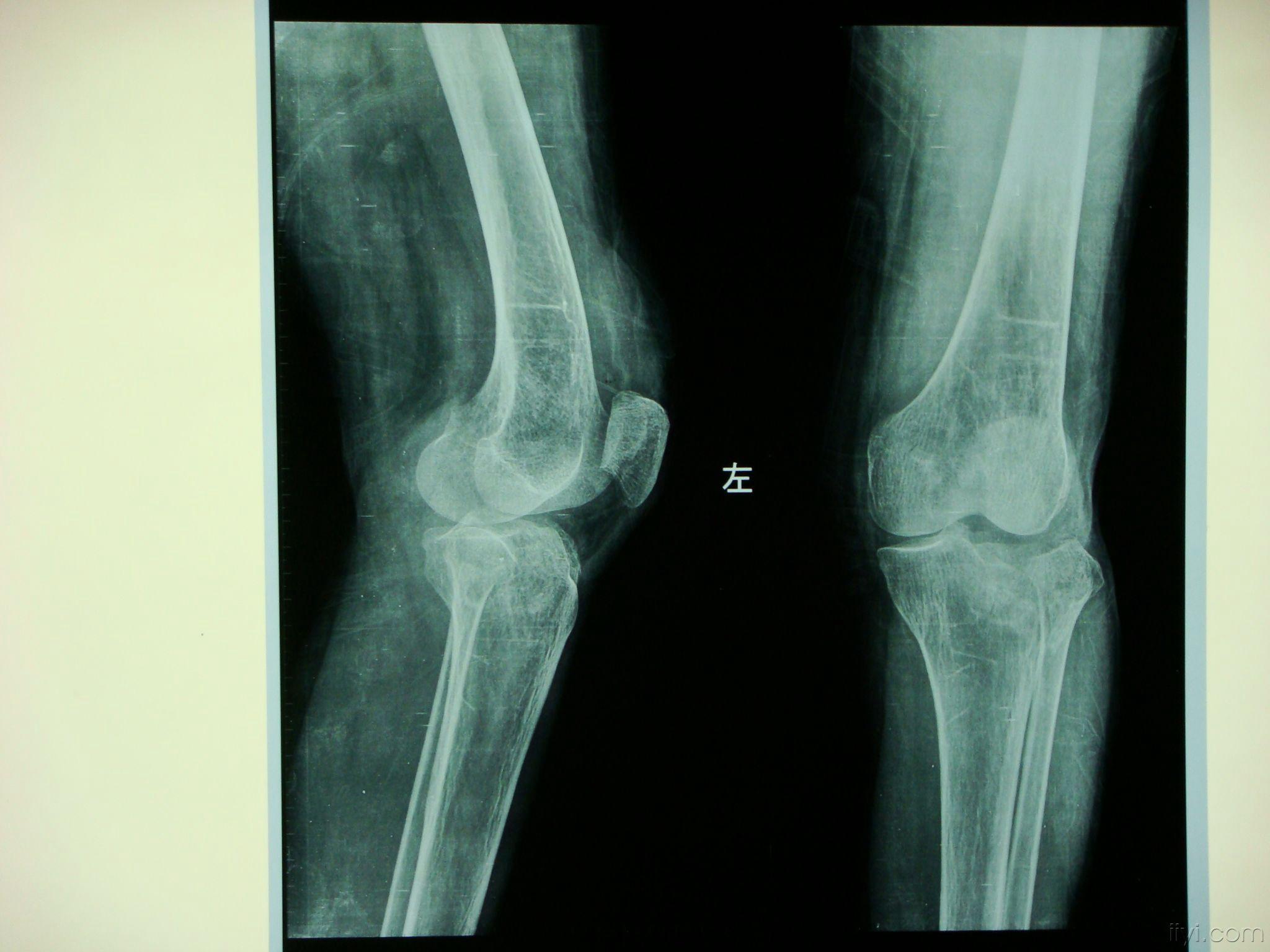 左胫骨平台骨折图片