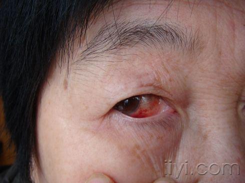 右眼巩膜出血斑求助专家
