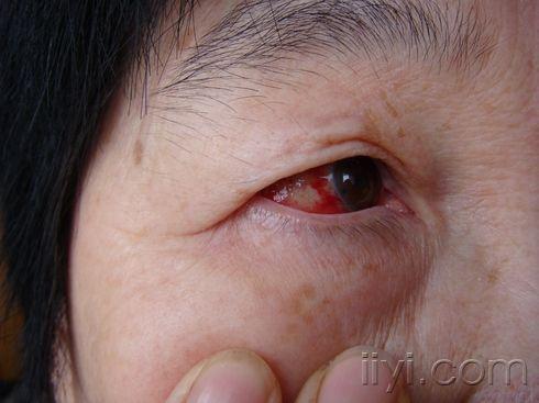 右眼巩膜出血斑求助专家