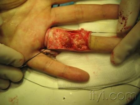 一例罕见手指骨巨细胞瘤
