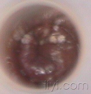 肛管疣图片