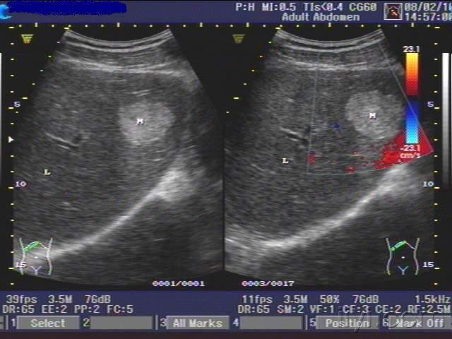 肝血管瘤超声表现图片图片
