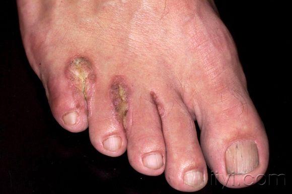 病例讨论45结果已公布