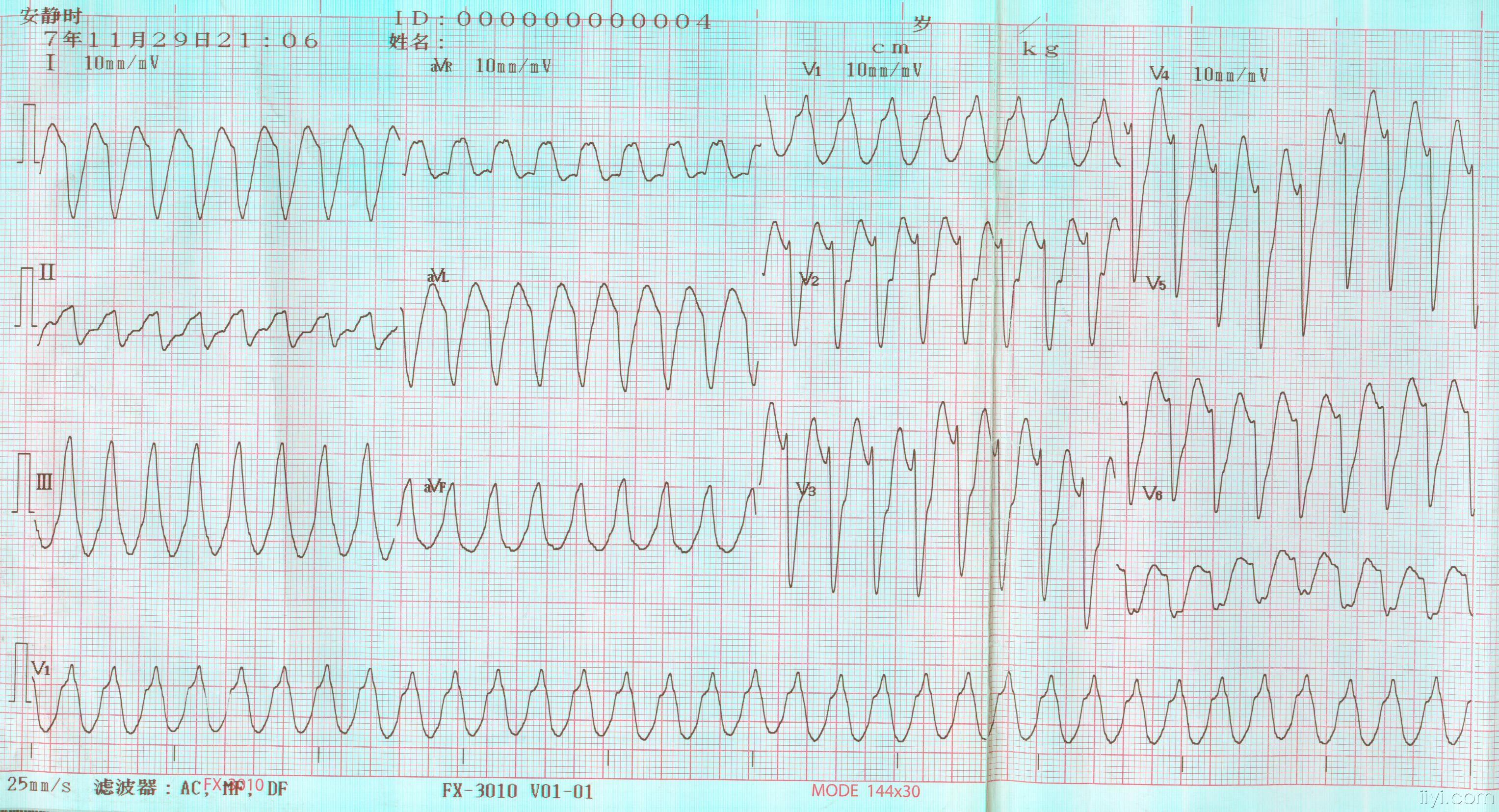 酷似室速的心电图图片