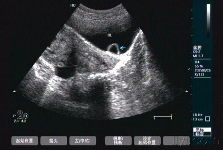 输尿管囊肿 超声医学讨论版 爱爱医医学论坛